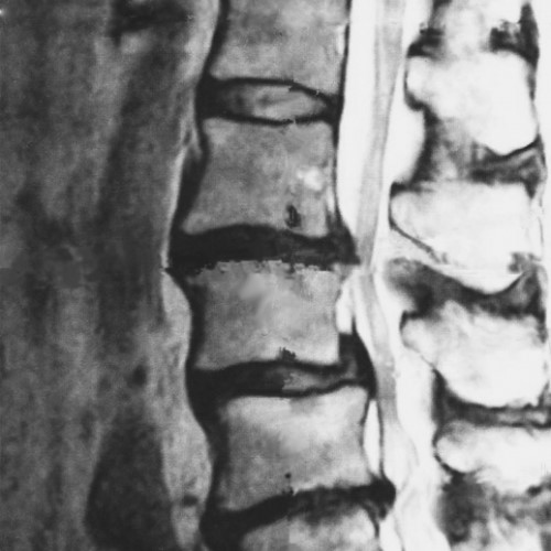 腰椎椎間板ヘルニアのMRI画像